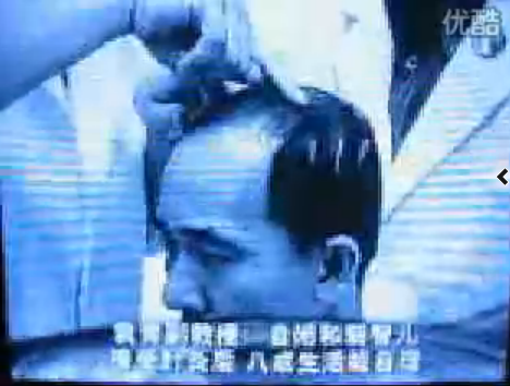国外媒体报道靳三针治疗儿童自闭症